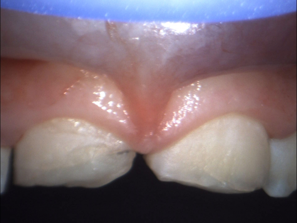 INJURY OF A 9-YEAR-OLD – BROKEN CROWNS OF THE UPPER INCISORS DOWN TO THE DENTAL PULP (NERVE)